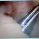 Imagen para el artículo titulado Un hombre acude al médico con un par de pinzas para el pelo en el interior del pene. Llevaba 4 años con ellas
